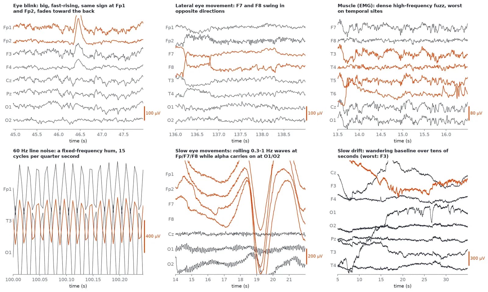 EEG artifact gallery from real recordings: eye blink at Fp1 and Fp2, lateral eye movement at F7 and F8, muscle EMG on temporal sites, 60 Hz line noise, slow eye movements and slow drift
